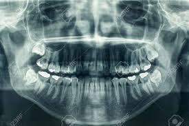 파노라마 치과용 X-Ray